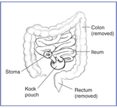 Diagram shows the colon(labeled) and rectum(labeled) have been removed. The ileum(labeled) is connect to an internal kock pouch(labeled) which is directed to an external stoma(labeled)