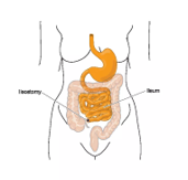 Diagram of where an ileostomy is placed. The ileum and ileostomy are labeled